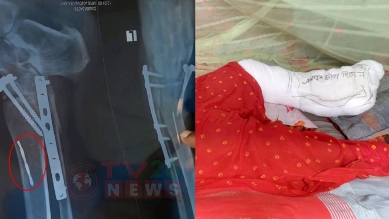 মেশিনের ফলা রেখে রোগীর পায়ে সেলাইয়ের ঘটনা তদন্তে কমিটি গঠন