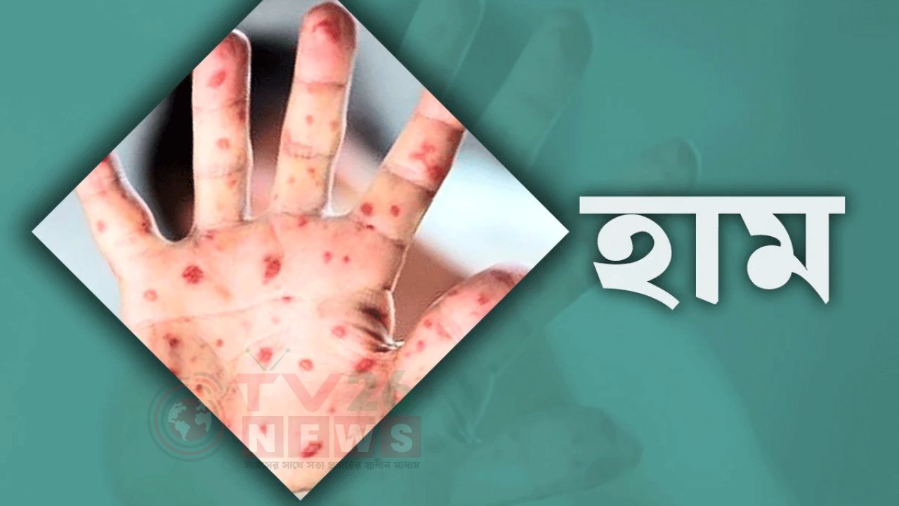 সারাদেশে হাম উপসর্গে আরো ৭ মৃত্যু