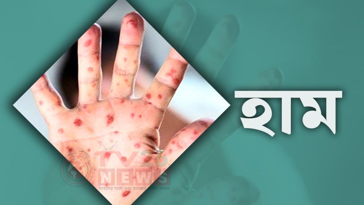২৪ ঘণ্টায় হাম উপসর্গে ৬ জনের মৃত্যু, আক্রান্ত ১২১৩