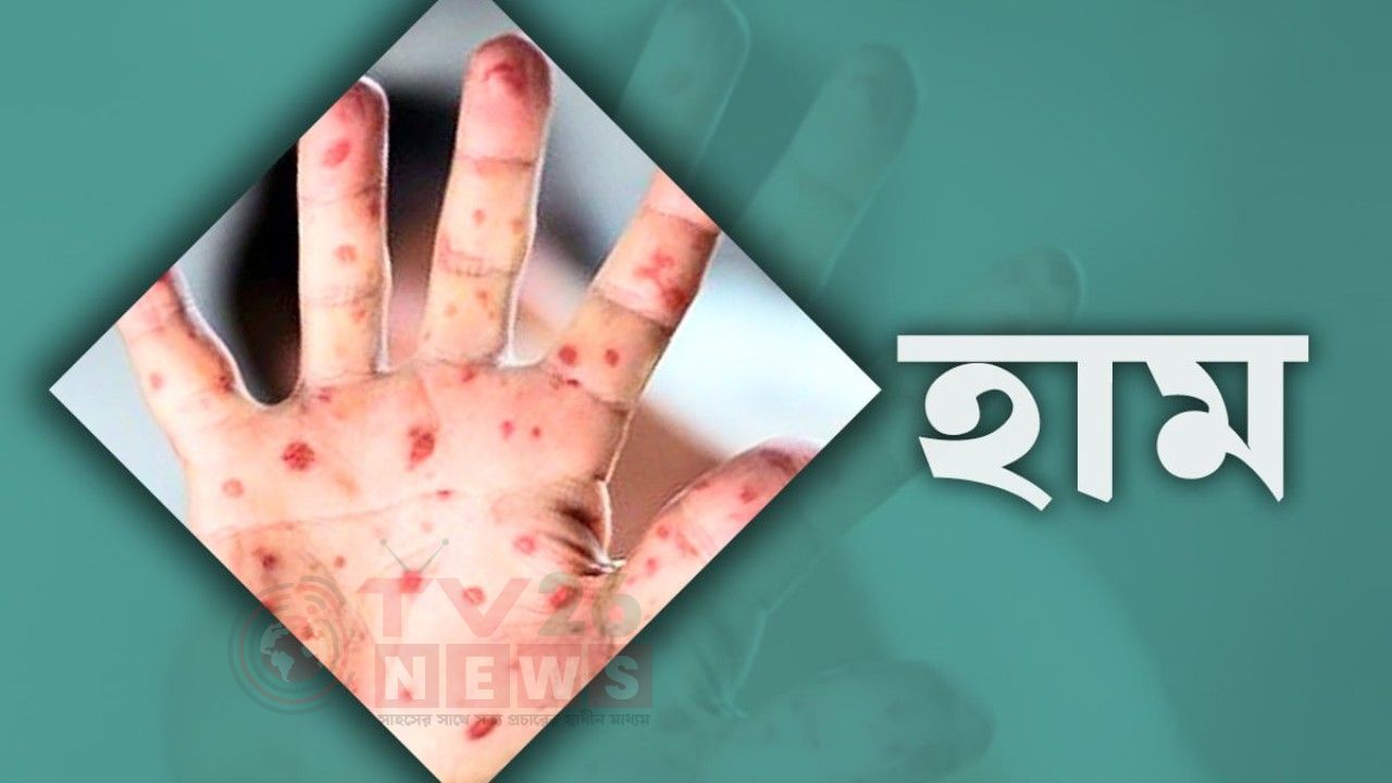 দেশে হাম ও উপসর্গে মৃত্যু ছাড়ালো ১২০০
