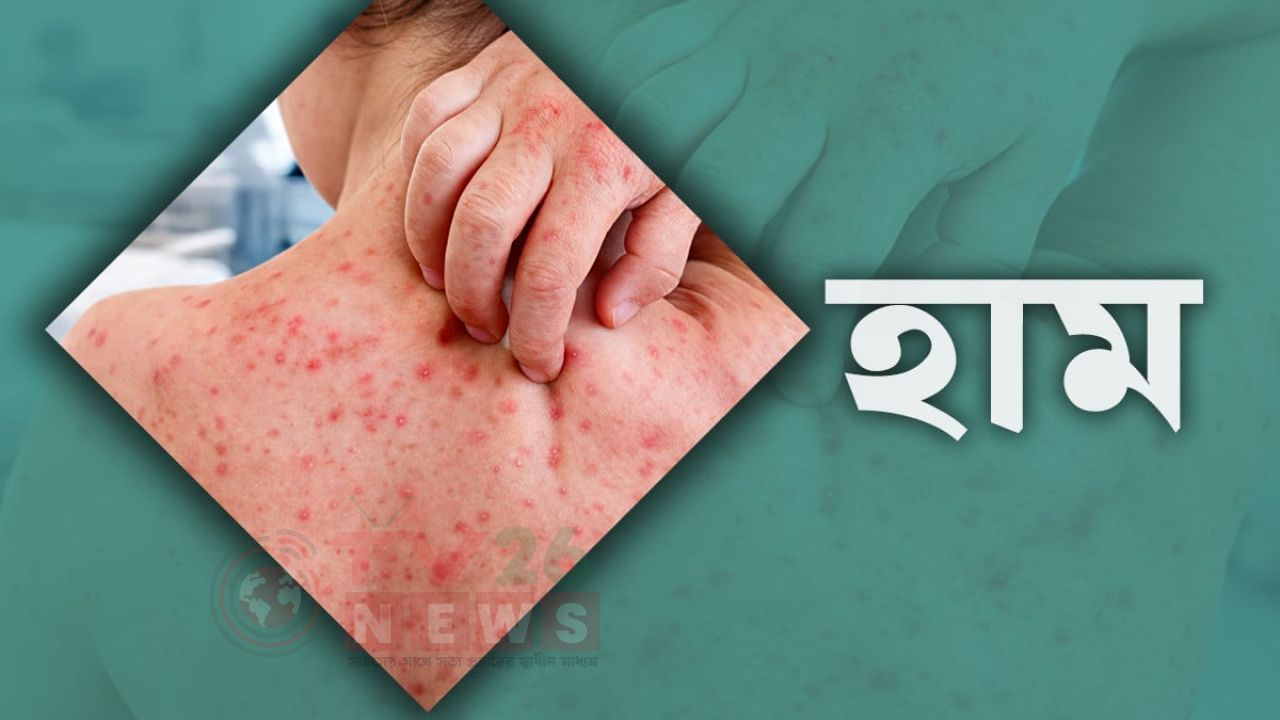 একদিনে হাম উপসর্গে ৮ জনের মৃত্যু, নতুন রোগী ১০৬৫
