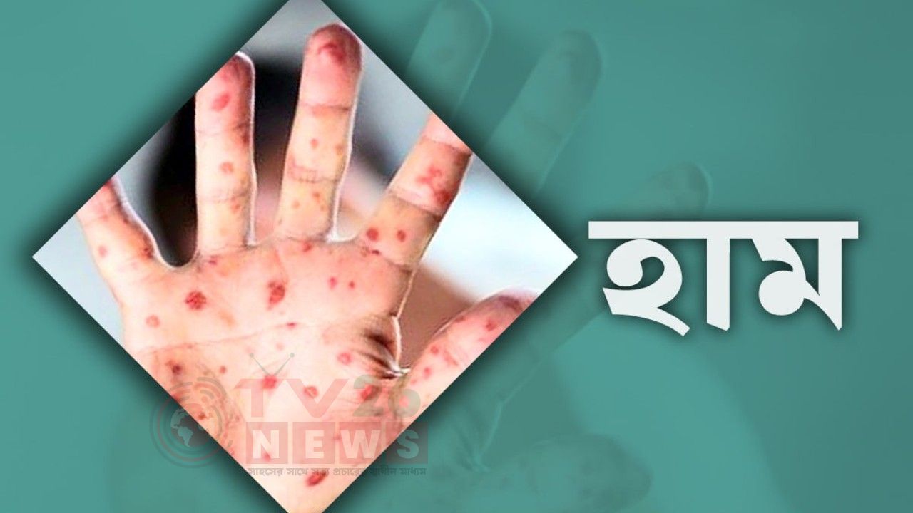 ২৪ ঘণ্টায় হাম ও হামের উপসর্গে আরও ৭ জনের মৃত্যু, আক্রান্ত ১২৯৫